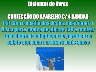 Disjuntor de Hyrax CONFECÇÃO DO APARELHO C/ 4 BANDAS 05) Com o auxílio dos dedos, posicionar o fio na parte cônica do alicate 139 e realizar uma dobra de adaptação do parafuso ao palato com uma curvatura mais suave 
