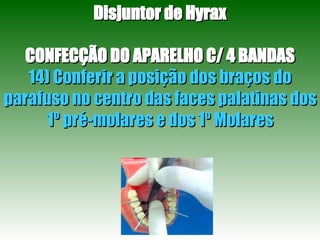 Disjuntor de Hyrax CONFECÇÃO DO APARELHO C/ 4 BANDAS 14) Conferir a posição dos braços do parafuso no centro das faces palatinas dos 1º pré-molares e dos 1º Molares 