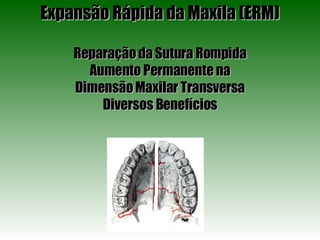 Expansão Rápida da Maxila (ERM) Reparação da Sutura Rompida Aumento Permanente na Dimensão Maxilar Transversa Diversos Benefícios 