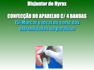 Disjuntor de Hyrax CONFECÇÃO DO APARELHO C/ 4 BANDAS 15) Marcar o local do corte das extremidades do parafuso 