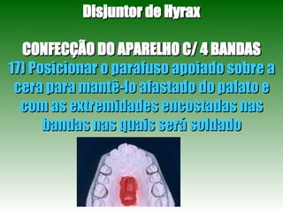 Disjuntor de Hyrax CONFECÇÃO DO APARELHO C/ 4 BANDAS 17) Posicionar o parafuso apoiado sobre a cera para mantê-lo afastado do palato e com as extremidades encostadas nas bandas nas quais será soldado 