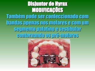Disjuntor de Hyrax MODIFICAÇÕES Também pode ser confeccionado com bandas apenas nos molares e com um segmento palatino e vestibular contornando os pré-molares 
