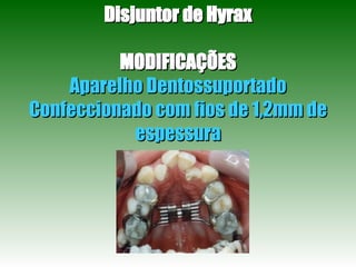 Disjuntor de Hyrax MODIFICAÇÕES Aparelho Dentossuportado Confeccionado com fios de 1,2mm de espessura 
