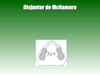 Disjuntor de McNamara 