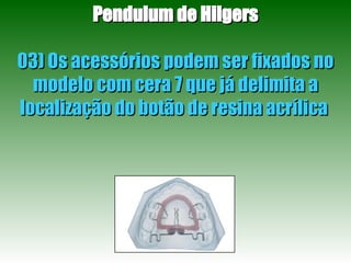 Pendulum de Hilgers 03) Os acessórios podem ser fixados no modelo com cera 7 que já delimita a localização do botão de resina acrílica  