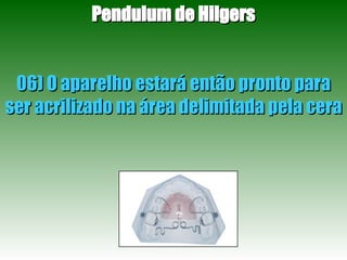 Pendulum de Hilgers 06) O aparelho estará então pronto para ser acrilizado na área delimitada pela cera  