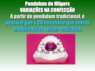 Pendulum de Hilgers VARIAÇÕES NA CONFECÇÃO A partir do pendulum tradicional, é  possível que o CD necessite que outras modificações sejam realizadas 