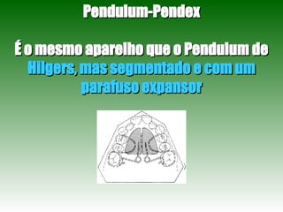 Pendulum-Pendex É o mesmo aparelho que o Pendulum de  Hilgers, mas segmentado e com um parafuso expansor 