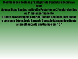 Modificações do Haas p/ Estágios de Dentadura Decídua e Mista Apenas Duas Bandas na Região Posterior no 2º molar decíduo ou 1º molar permanente O Dente de Ancoragem Anterior (Canino Decíduo) Sem Banda e com uma Extensão da Barra de Conexão Abraçando o Dente à semelhança de um Grampo em “ C ” 