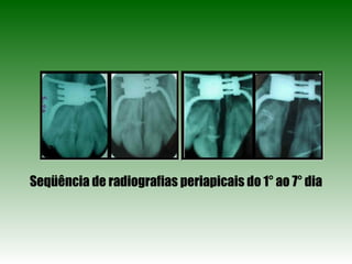 Seqüência de radiografias periapicais do 1° ao 7° dia 