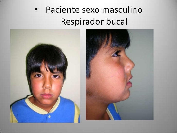 Expansores Maxilares