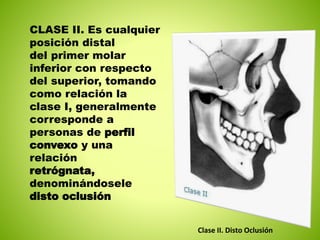 CLASE II. Es cualquier 
posición distal 
del primer molar 
inferior con respecto 
del superior, tomando 
como relación la 
clase I, generalmente 
corresponde a 
personas de perfil 
convexo y una 
relación 
retrógnata, 
denominándosele 
disto oclusión 
Clase II. Disto Oclusión 
 
