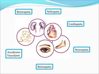 Neuropatía
Nefropatía
Retinopatía
Cardiopatía
Accidentes
Vasculares
Retinopatía
 