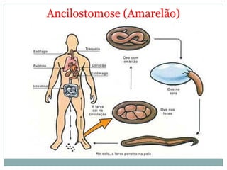 Ancilostomose (Amarelão)
 