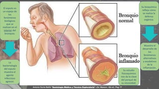 El esputo es
un espejo de
los
fenómenos
biológicos
que se
realizan en el
interior del
bronquio.
La
bacteriología
del esputo
muestra el
agente
infeccioso
agresor.
Su bioquímica
refleja cómo
se realiza la
defensa
orgánica.
Muestra el
desarrollo de
los
fenómenos
alternativos
y exudativos
de la
inflamación.
Su estudio
fisicoquímico
nos da la clave
del porqué de
su viscosidad.
Antonio Surós Batlló "Semiología Médica y Técnica Exploratoria".- Ed. Masson.- 8ta ed.- Pag: 77
 