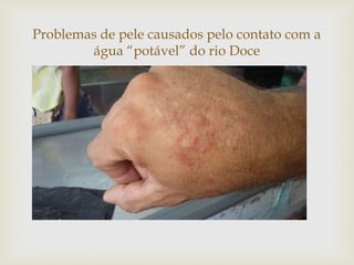 
Problemas de pele causados pelo contato com a
água “potável” do rio Doce
 