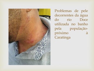 Problemas de pele
decorrentes da água
do rio Doce
utilizada no banho
pela população-
próximo à
Caratinga
 