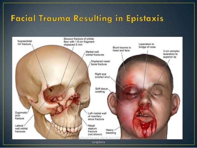 Blunt Facial Trauma 84