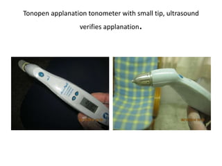 Tonopen applanation tonometer with small tip, ultrasound
verifies applanation.
 