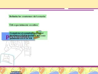 Exploración física Clínica de Cardiología percusión Delimita los contornos del corazón Útil especialmente en niños Completar el complejo pulmonar de Chávez con la matidez del cono pulmonar en el 2o EII 