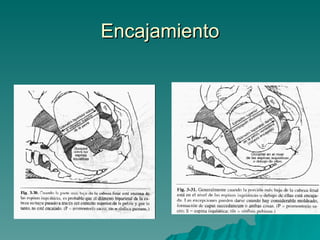 Encajamiento 