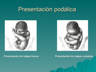 Presentación podálica  Presentación de nalgas franca   Presentación de nalgas completa  