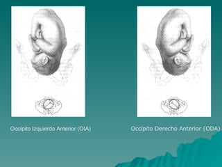 Occípito Izquierdo Anterior (OIA)  Occípito Derecho Anterior (ODA) 