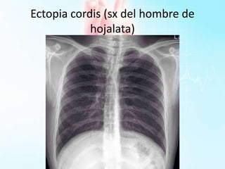 Ectopia cordis (sx del hombre de
hojalata)
 