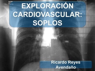 EXPLORACIÓN
CARDIOVASCULAR:
SOPLOS
Ricardo Reyes
Avendaño
 