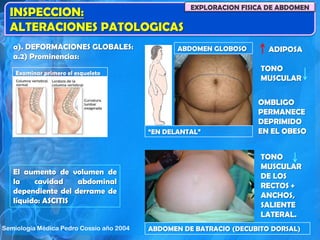 INSPECCION:
ALTERACIONES PATOLOGICAS
EXPLORACION FISICA DE ABDOMEN
a). DEFORMACIONES GLOBALES:
a.2) Prominencias:
Examinar primero el esqueleto
ABDOMEN GLOBOSO
“EN DELANTAL”
ADIPOSA
TONO
MUSCULAR
OMBLIGO
PERMANECE
DEPRIMIDO
EN EL OBESO
ABDOMEN DE BATRACIO (DECUBITO DORSAL)
TONO
MUSCULAR
DE LOS
RECTOS +
ANCHOS,
SALIENTE
LATERAL.
El aumento de volumen de
la cavidad abdominal
dependiente del derrame de
líquido: ASCITIS
Semiología Médica Pedro Cossio año 2004
 