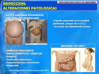 INSPECCION:
ALTERACIONES PATOLOGICAS
EXPLORACION FISICA DE ABDOMEN
ASCITIS: ABDOMEN PROMINENTE,
CON OMBLIGO DESPEGLADO.
-Líquido contenido en la cavidad
peritoneal, (mayor de 4 o 5 L)
- Se asocia con hipertensión portal
ABDOMEN “EN OBUS”
-OMBLIGO PROCIDENTE
“ONFALOPREPTOSIS” (DEDO DE
GUANTE)
-Peritonitis tuberculosa
-Tumores ováricos voluminosos
-Megacolon
Semiología Médica Pedro Cossio año 2004
 