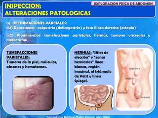 INSPECCION:
ALTERACIONES PATOLOGICAS
EXPLORACION FISICA DE ABDOMEN
b). DEFORMACIONES PARCIALES:
b.1) Depresiones: epigastrio (dolicogastria) y fosa ilíaca derecha (ectopia)
b.2) Prominencias: tumefacciones parietales, hernias, tumores viscerales y
meteorismo
TUMEFACCIONES
PARIETALES:
Tumores de la piel, músculos,
abscesos y hematomas.
HERNIAS: “Sitios de
elección” o “zonas
herniarias” línea
blanca, región
inguinal, el triángulo
de Petit y línea
Spiegel.
 