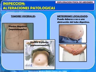 METEORISMO LOCALIZADO:
Puede deberse o no a una
obstrucción del tubo digestivo.
INSPECCION:
ALTERACIONES PATOLOGICAS
EXPLORACION FISICA DE ABDOMEN
Vientre Hepático
(hepatomegalia)
Vientre Esplénico
(esplenomegalia)
TUMORES VISCERALES:
 