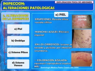 INSPECCION:
ALTERACIONES PATOLOGICAS
EXPLORACION FISICA DE ABDOMEN
a) PIEL
HERPES
ZOSTER
a) Piel
b) Ombligo
c) Sistema Piloso
d) Sistema
Venoso
Semiología Médica Pedro Cossio año 2004
 