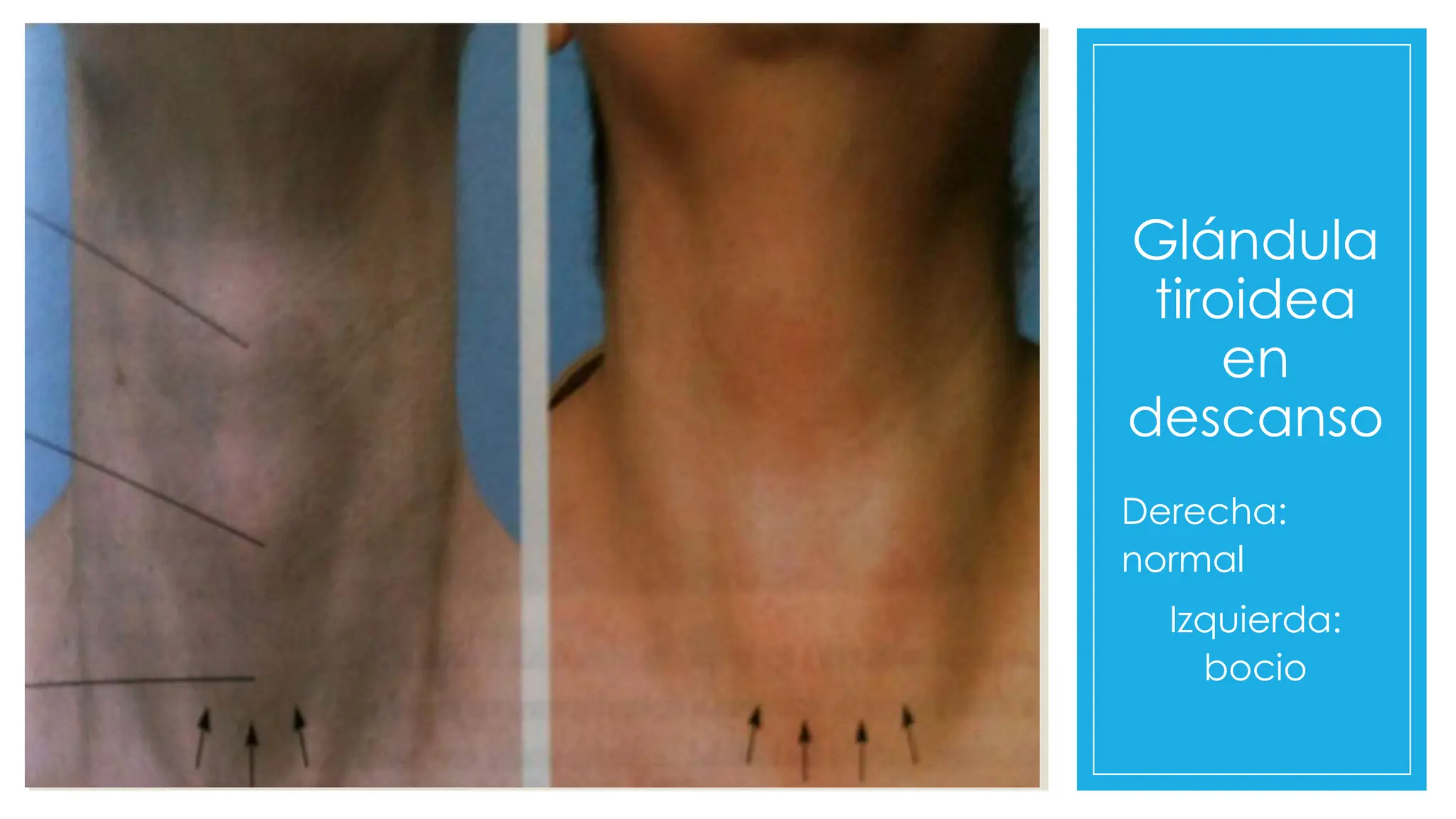 Glándula
tiroidea
en
descanso
Derecha:
normal
Izquierda:
bocio
 