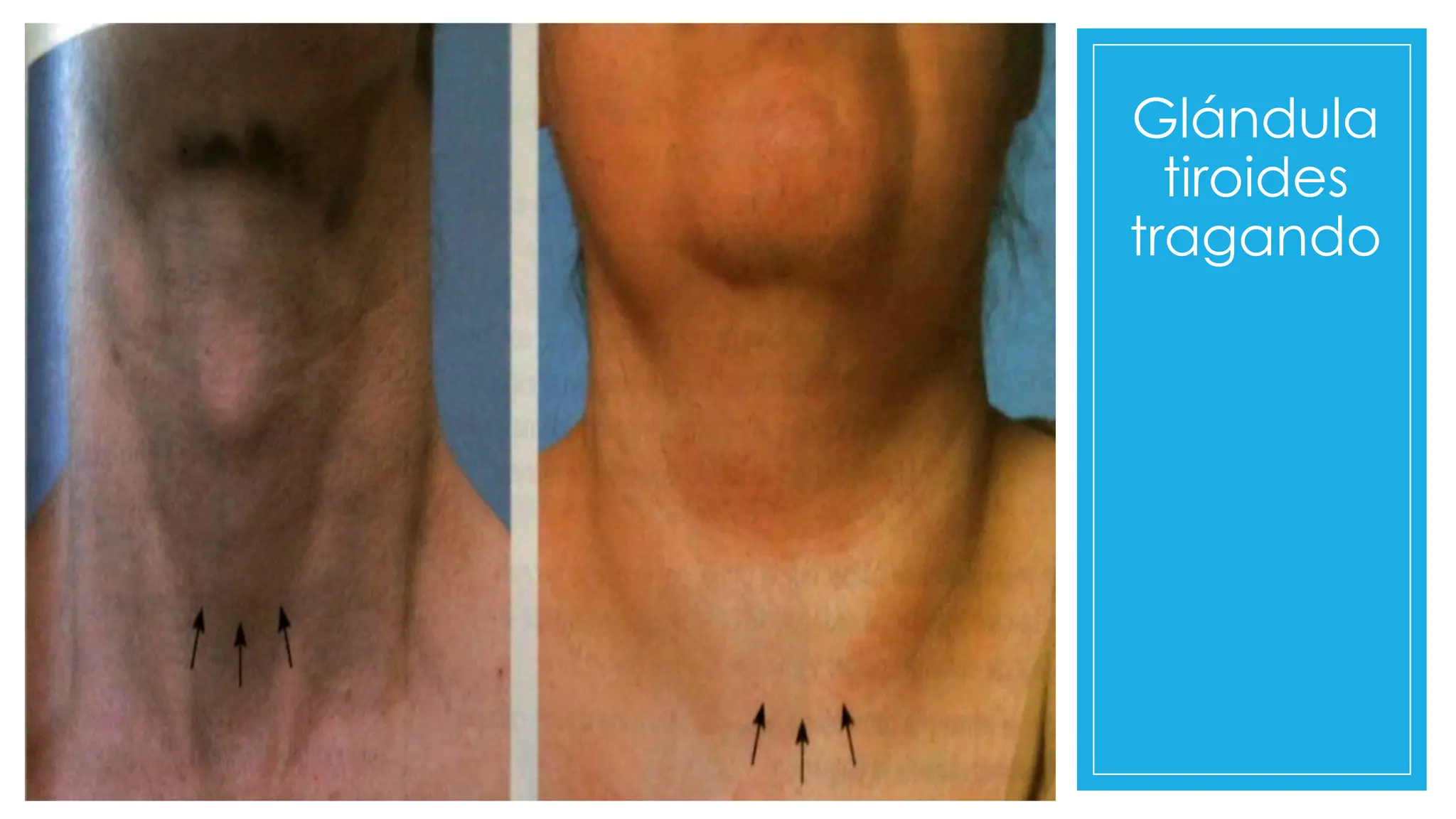 Glándula
tiroides
tragando
 