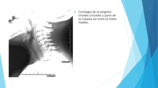  Cartilagos de la epiglotis
tiroides cricoides y parte de
la traquea asi como el hueso
hioides.
 