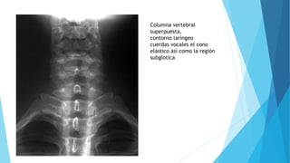 Columna vertebral
superpuesta,
contorno laríngeo
cuerdas vocales el cono
elástico así como la región
subglotica
 