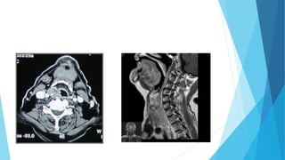 Exploración y semiologia de la laringe