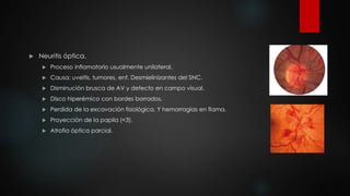  Neuritis óptica. 
 Proceso inflamatorio usualmente unilateral. 
 Causa: uveítis, tumores, enf. Desmielinizantes del SNC. 
 Disminución brusca de AV y defecto en campo visual. 
 Disco hiperémico con bordes borrados. 
 Perdida de la excavación fisiológica. Y hemorragias en flama. 
 Proyección de la papila (<3). 
 Atrofia óptica parcial. 
 