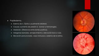  Papiledema. 
 Edema de n. Óptico usualmente bilateral. 
 Causas: aumento de presión ic (tumor o hemorragia). 
 Medición. Diferencia entre lentes positivas. 
 Márgenes borrados, enrojecimiento y elevación leve o nula. 
 Elevación pronunciada, vasos tortuosos y edema de la retina. 
 
