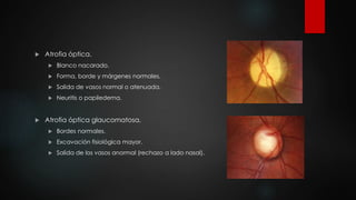  Atrofia óptica. 
 Blanco nacarado. 
 Forma, borde y márgenes normales. 
 Salida de vasos normal o atenuada. 
 Neuritis o papiledema. 
 Atrofia óptica glaucomatosa. 
 Bordes normales. 
 Excavación fisiológica mayor. 
 Salida de los vasos anormal (rechazo a lado nasal). 
 