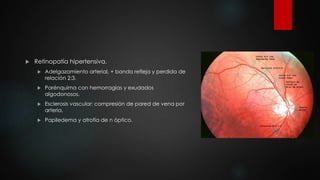  Retinopatía hipertensiva. 
 Adelgazamiento arterial, + banda refleja y perdida de 
relación 2:3. 
 Parénquima con hemorragias y exudados 
algodonosos. 
 Esclerosis vascular: compresión de pared de vena por 
arteria. 
 Papiledema y atrofia de n óptico. 
 