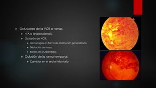 Oclusiones de la VCR o ramas. 
 HTA o angioesclerosis. 
 Oclusión de VCR. 
 Hemorragias en flama de distribución generalizada. 
 Dilatación de vasos 
 Bordes del DO perdidos. 
 Oclusión de la rama temporal. 
 Cambios en el sector tributario. 
 