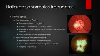 Hallazgos anormales frecuentes. 
 Nervio óptico. 
 Coloboma del n. Óptico. 
 Trastorno unilateral congénito. 
 Cierre inadecuado de copa óptica fetal. 
 Fosita en el borde del NO, salida anómala de vasos y en 
coroides. 
 Zona blanquecina arqueada bajo el NO. 
 Persistencia de fibras mielinizadas. 
 Mielinización termina en lamina cribosa. 
 Haces de color blanco con márgenes en pluma. 
 Variante anatómica. 
 