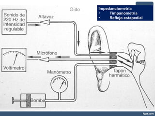 Impedanciometría
• Timpanometría
• Reflejo estapedial
 