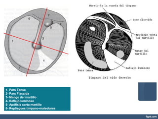 1- Pars Tensa
2- Pars Flaccida
3- Mango del martillo
4- Reflejo luminoso
5- Apófisis corta martillo
6- Repliegues tímpano-maleolares
 