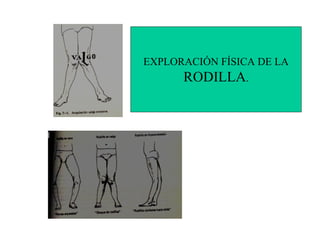 EXPLORACIÓN FÍSICA DE LA
      RODILLA.
 