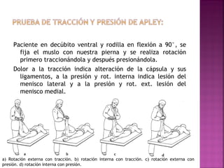 Paciente en decúbito ventral y rodilla en flexión a 90°, se
fija el muslo con nuestra pierna y se realiza rotación
primero traccionándola y después presionándola.
Dolor a la tracción indica alteración de la cápsula y sus
ligamentos, a la presión y rot. interna indica lesión del
menisco lateral y a la presión y rot. ext. lesión del
menisco medial.

a) Rotación externa con tracción. b) rotación interna con tracción. c) rotación externa con
presión. d) rotación interna con presión.

 