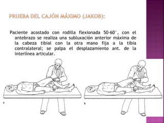 Paciente acostado con rodilla flexionada 50-60°, con el
antebrazo se realiza una subluxación anterior máxima de
la cabeza tibial con la otra mano fija a la tibia
contralateral; se palpa el desplazamiento ant. de la
interlínea articular.

 
